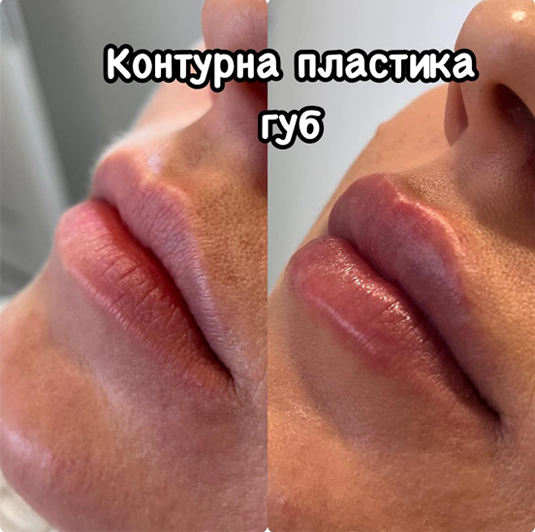 Контурна пластика губ - Клініка Сімейна