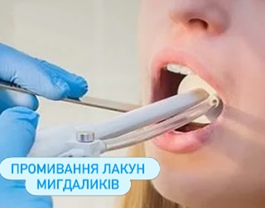 Промивання лакун мигдаликів - Клініка Сімейна